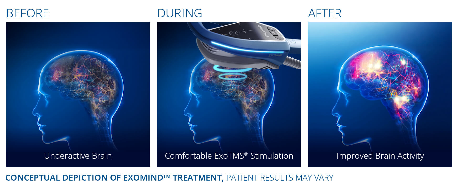 Exomind rTMS treatment sequence showing patient setup before, during, and after a session